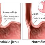 Achalázie jícnu – příznaky, projevy nemoci a léčba