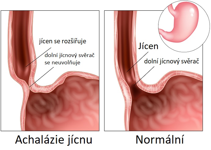 Achalázie jícnu - ilustrace