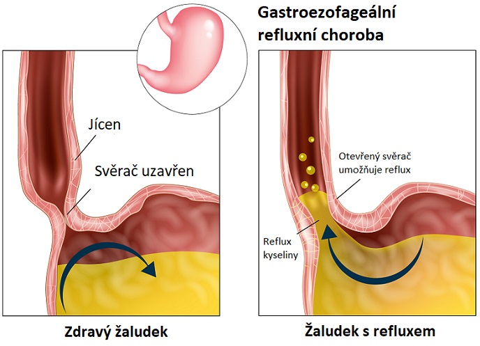 Reflux kyseliny ze žaludku - ilustrace