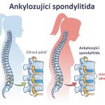 Ankylozující spondylitida (Bechtěrevova nemoc) – jak ji léčit přirozeně?