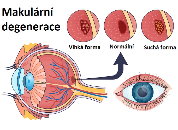 Makulární degenerace - ilustrace