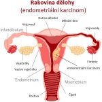 Rakovina dělohy (endometriální karcinom) – příznaky, příčiny, léčba