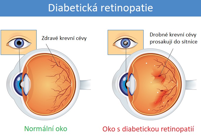 Diabetická retinopatie - ilustrace