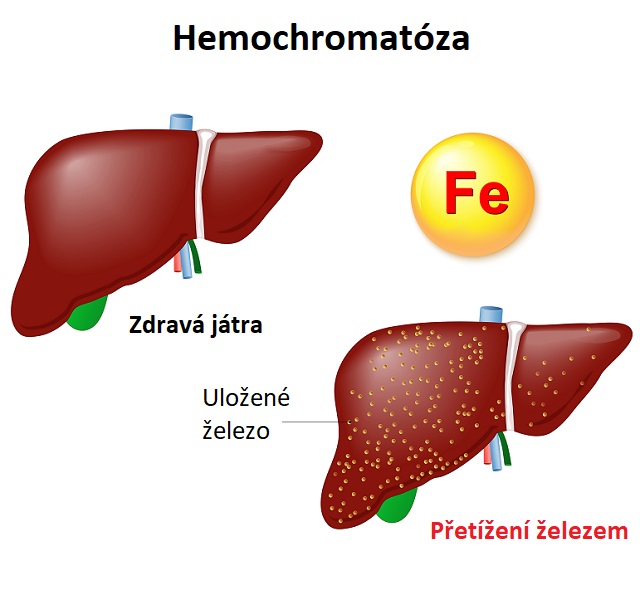 Hemochromatóza - nadměrné ukládání železa v těle - ilustrace