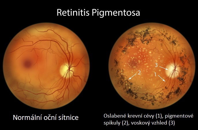 Retinitis pigmentosa (pigmentová retinitida) - ilustrace