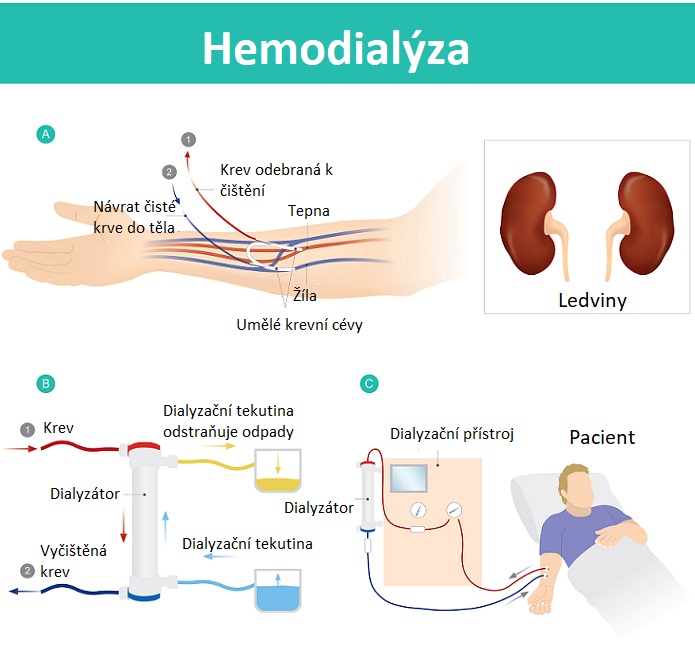 Hemodialýza - ilustrace