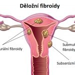 Myomektomie – odstranění děložních myomů při zachování dělohy
