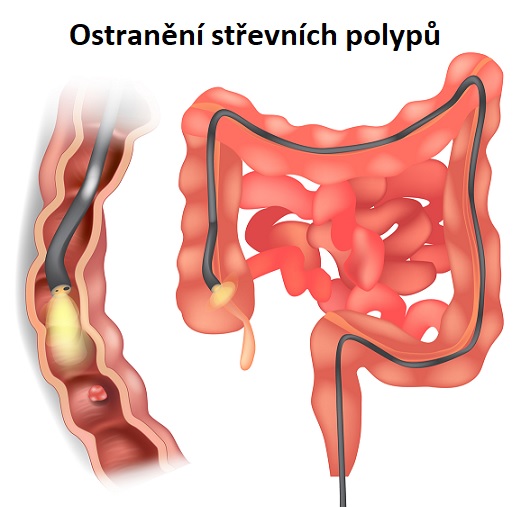 Lékař pravděpodobně odstraní vaše polypy během kolonoskopie.