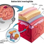 22 příznaků meningitidy – kompletní přehled