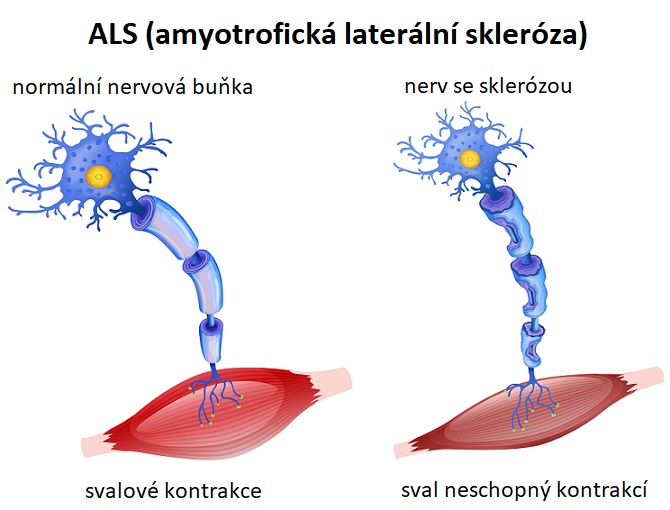 ALS (amyotrofická laterální skleróza) - ilustrace