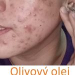 Olivový olej na akné – může oliváč fungovat na akné?