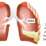 Pleurodéza – aplikace léčivé látky do pohrudniční dutiny – kdy a jak se provádí?