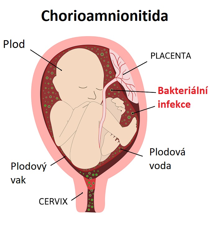 Chorioamnionitida - zánět plodových obalů (choria, amnia) - ilustrace