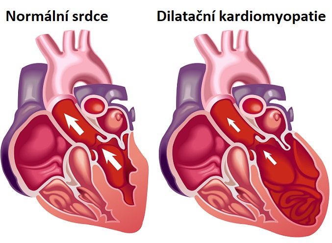 Dilatační kardiomyopatie - ilustrace