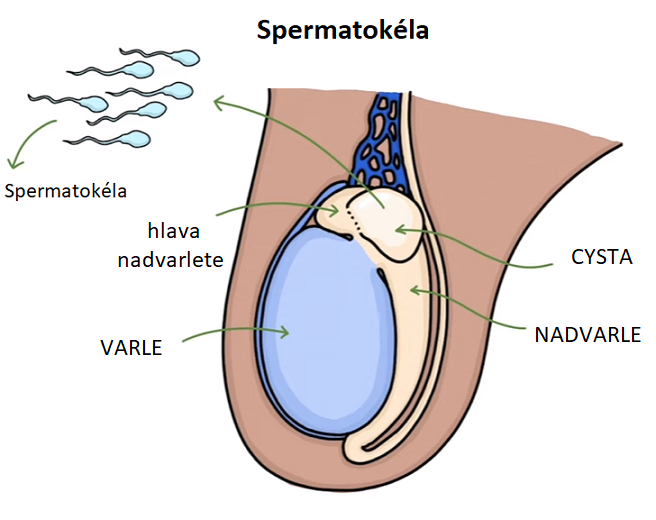 Spermatokéla - ilustrace