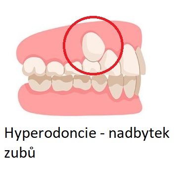 Hyperodoncie je termín značící přítomnost nadpočetných zubů v chrupu