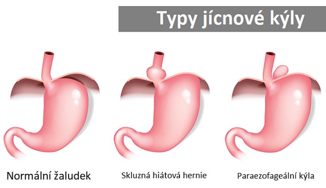 Jícnová kýla (hiátová hernie) - ilustrace