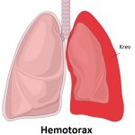 Hemotorax –  krev mezi hrudní stěnou a plícemi – příznaky, příčiny a léčba