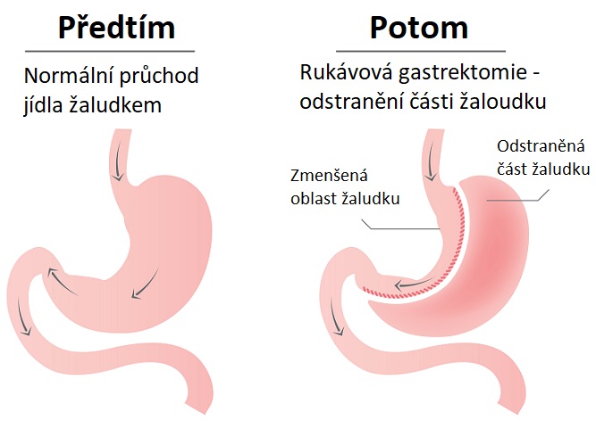 Rukávovitá resekce žaludku - ilustrace