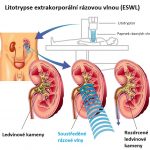 Litotrypse rázovými vlnami (ESWL) – neinvazivní rozbití ledvinových a žlučových kamenů