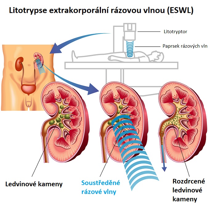 Litotripse rázovými vlnami - ilustrace