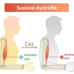 Svalová dystrofie – skupina genetických onemocnění – příznaky, příčiny a léčba