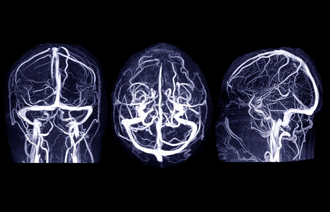 Venografie je diagnostická zobrazovací metoda používaná k vyšetření žilního systému