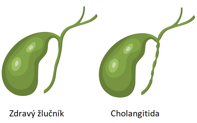 Cholangitida - ilustrace