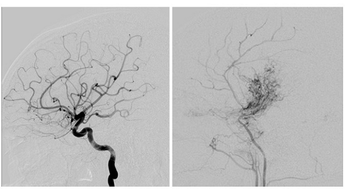 Tyto obrázky ukazují krevní cévy v mozku u osoby s normálním cévním systémem (vlevo) ve srovnání s cévami u pacienta s chorobou moyamoya (vpravo).