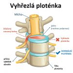 Diskektomie – odstranění meziobratlové ploténky – kdy a jak se provádí?