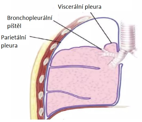 Bronchopleurální píštěl - ilustrace