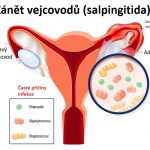 Zánět vejcovodů (salpingitida) – příznaky, příčiny + jak se léčí?