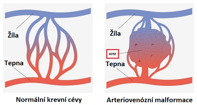 arteriovenózní malformace - ilustrace