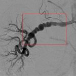 Fibromuskulární dysplazie – abnormální růst buněk ve stěně tepen – příznaky, příčiny a léčba