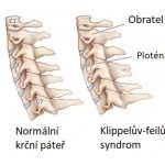 Klippelův-feilův syndrom – příznaky, příčiny a léčba