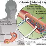 Cukrovka (diabetes) 1. typu – příznaky, příčiny a léčba