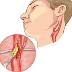 Endarterektomie – odstranění nahromadění plaku ze zúžených nebo zablokovaných tepen – kdy a jak se provádí?