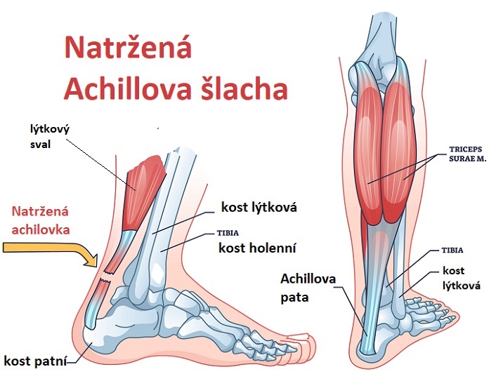 Natržená achilovka (Achillova šlacha) - ilustrace