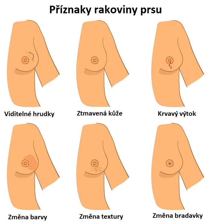 Příznaky rakoviny prsu - ilustrace