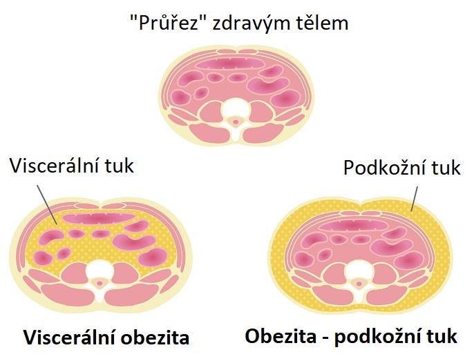 Viscerální obezita - ilustrace