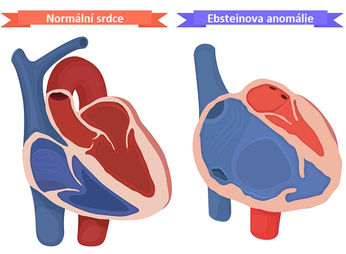 Ebsteinova anomálie - ilustrace