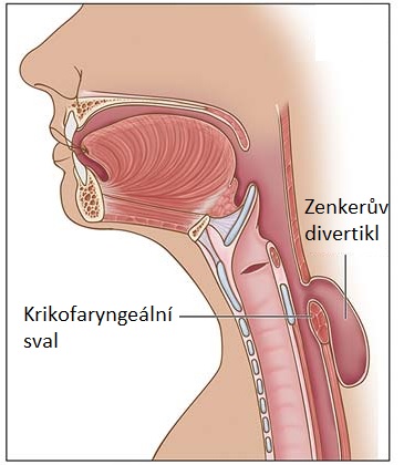 Zenkerův divertikl