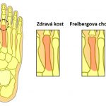 Freibergova choroba – příznaky, příčiny a léčba