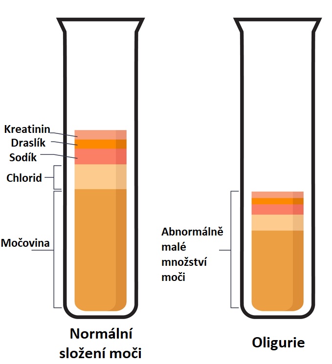 Oligurie - ilustrace