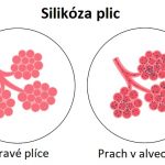 Silikóza plic – plicní onemocnění způsobené vdechováním křemičitého prachu