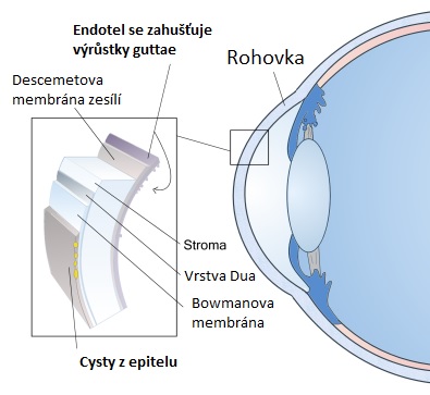 Fuchsova dystrofie