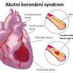 Akutní koronární syndrom – náhlé omezení průtoku krve do srdečního svalu – příznaky, příčiny a léčba