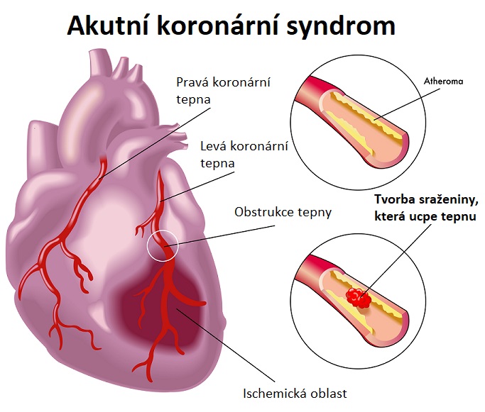 Akutní koronární syndrom - ilustrace