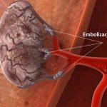 Embolizace – záměrné uzavření krevní cévy – kdy a jak se používá?