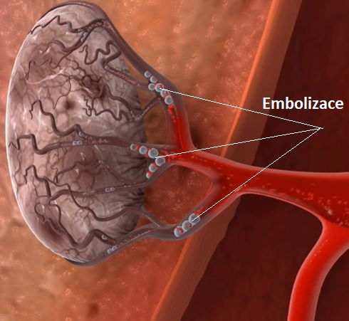 Embolizace nádoru - ilustrace